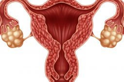 Una mujer con ovarios poliquísticos tiene mayores posibilidades de pérdidas, desarrollo de diabetes gestacional y alzas de presión sanguínea.